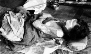 A Nagasaki victim who had received medical care in August 1945. A Nagasaki victim who had received medical care in August 1945.