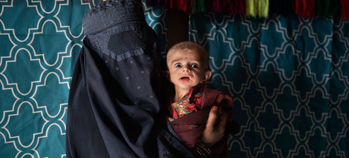 Mother brings her severely malnourished 7-month-old baby to a mobile health and nutrition team in a village at Maiwand District of Kandahar province, Afghanistan. Mother brings her severely malnourished 7-month-old baby to a mobile health and nutrition team in a village at Maiwand District of Kandahar province, Afghanistan.