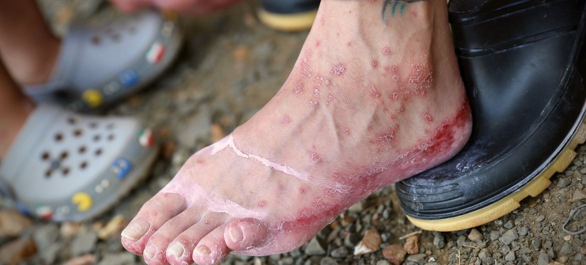 A migrant arrived in Lajas Blancas, Panama, with his feet covered in blood.