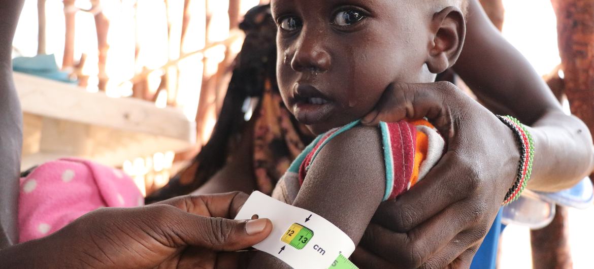 A malnourished child is assessed at a nutrition clinic in Fangak county, South Sudan. A malnourished child is assessed at a nutrition clinic in Fangak county, South Sudan.