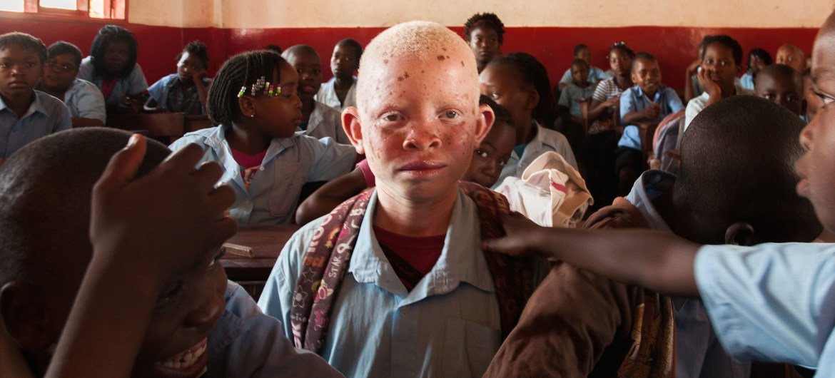 Lucas and his brother both have albinism, which makes their skin very sensitive, their eyesight poor, and their appearance a little different from their brothers and sisters.