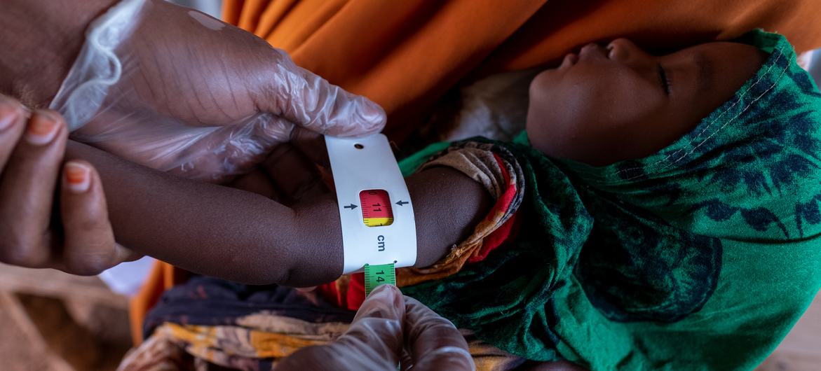 A child of seven months is being examined for malnutrition due to the severe drought in Somalia. A child of seven months is being examined for malnutrition due to the severe drought in Somalia.