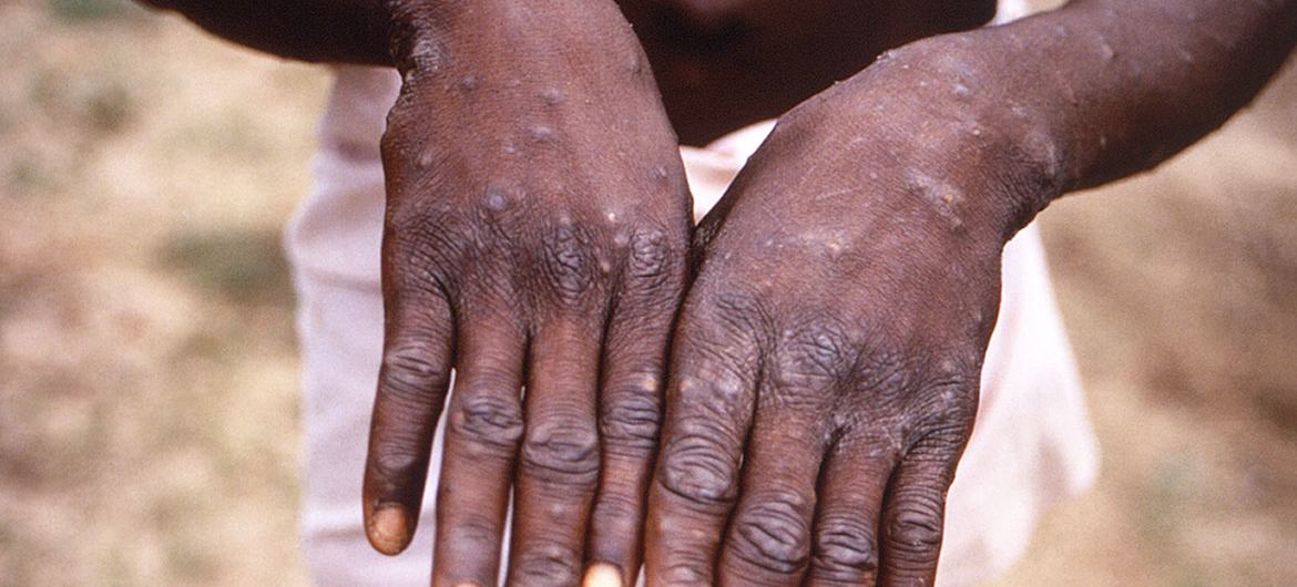 A young man shows his hands during an outbreak of monkeypox in the Democratic Republic of Congo.  (case)