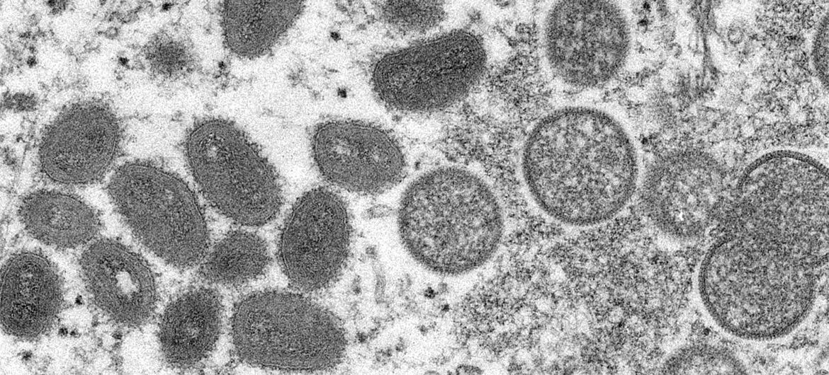 Monkeypox, şu anda eradike edilmiş çiçek hastalığı virüsüne benzer nadir fakat tehlikeli bir enfeksiyondur. 