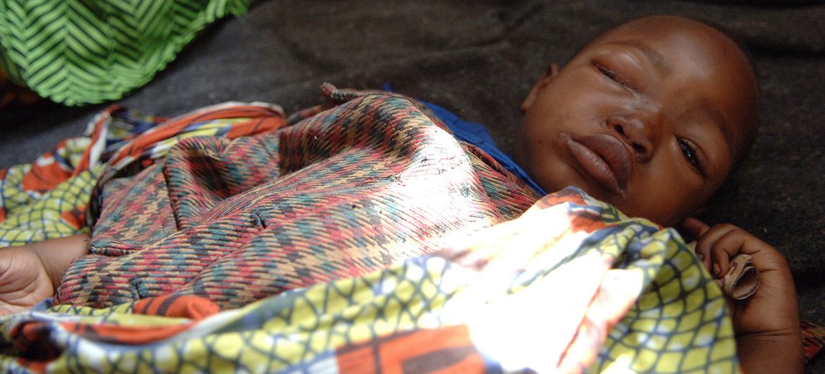 A five-year-old boy suffering from monkeypox rests in a health centre in a displaced camp in North Kivu, Democratic Republic of the Congo. (file) A five-year-old boy suffering from monkeypox rests in a health centre in a displaced camp in North Kivu, Democratic Republic of the Congo. (file)