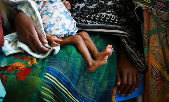 A severely malnourished child at a clinic in Ethiopia A severely malnourished child at a clinic in Ethiopia