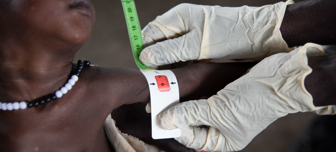 A nutrition worker measures the arm of a severely malnourished baby at a clinic in South Sudan. A nutrition worker measures the arm of a severely malnourished baby at a clinic in South Sudan.