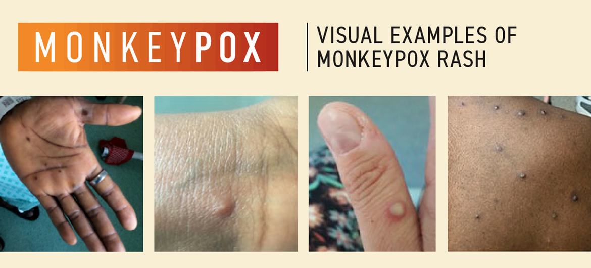 The World Health Organization (WHO) continues to work with patients and community advocates to develop and deliver information tailored to communities affected by monkeypox. 