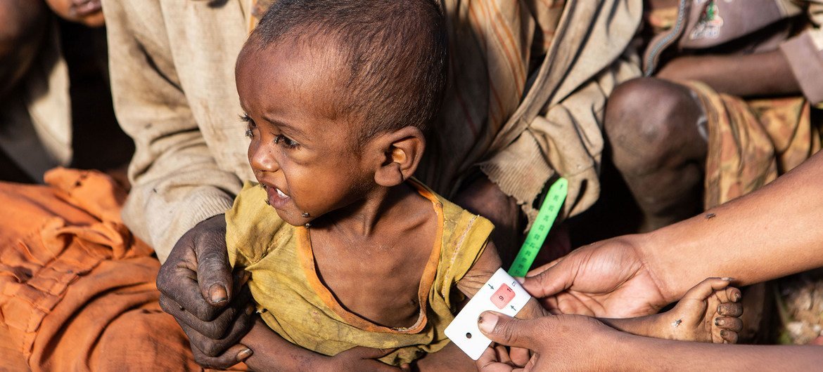 Children under five are among the most affected by malnutrition in southern Madagascar. Children under five are among the most affected by malnutrition in southern Madagascar.