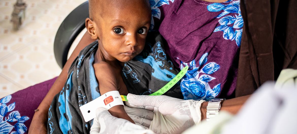 A one-year-old boy suffering from severe malnutrition gets his upper arm circumference measured at a hospital in Dolow, Ethiopia. A one-year-old boy suffering from severe malnutrition gets his upper arm circumference measured at a hospital in Dolow, Ethiopia.
