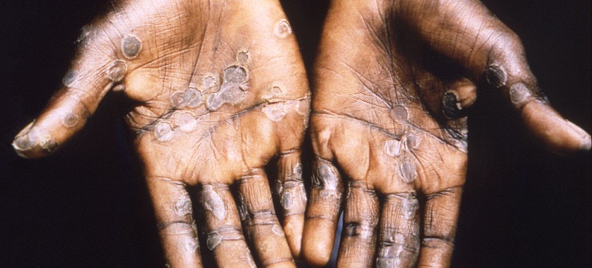 Monkeypox lezyonları genellikle avuç içlerinde görülür.