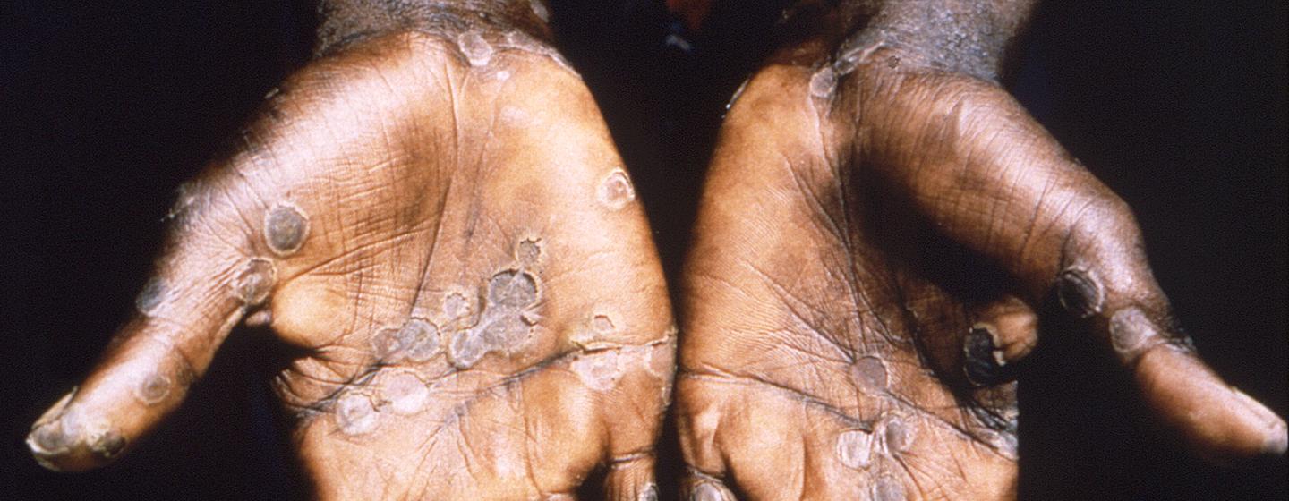Monkeypox lesions often appear on the palms of hands. Monkeypox lesions often appear on the palms of hands.
