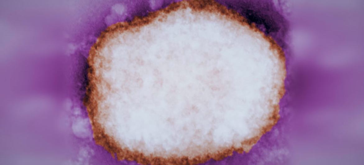 A highly-magnified image shows a mulberry-type Monkeypox virus particle, which was found in the fluid of a human blister. A highly-magnified image shows a mulberry-type Monkeypox virus particle, which was found in the fluid of a human blister.